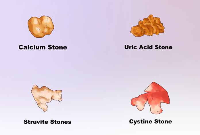 kidney stone – symptoms, causes, prevention and treatment