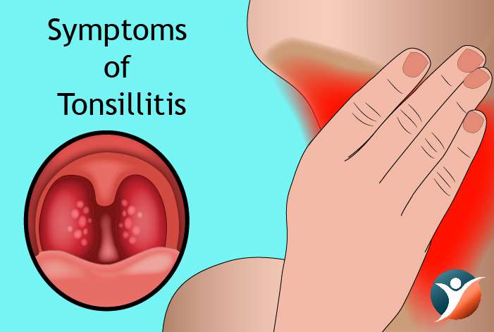 Tonsillitis Symptoms Causes Prevention And Treatments