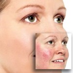 Treatment-of-Rosacea