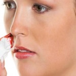 nose bleedign