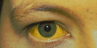 Contracted hepatitis A on San Diego trip, tourists reported