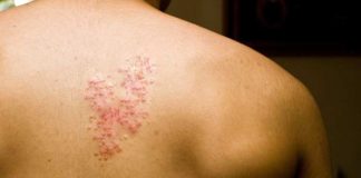 fda approval for new shingles vaccine shingrix