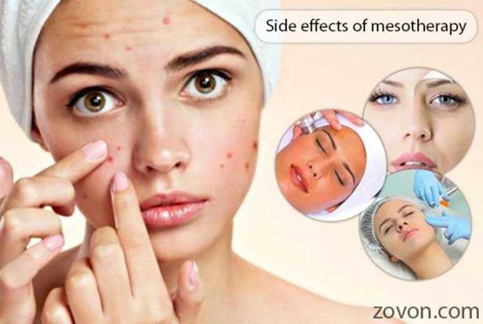 side effects of mesotherapy