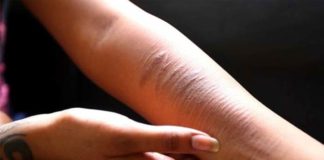 Upsurge in self-harming behavior among teenage girls, British study suggests upsurge in self harming behavior among teenage girls british study suggests