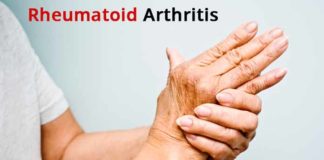 rheumatoid arthritis