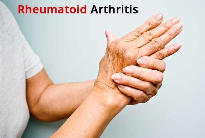 rheumatoid arthritis