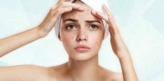 13 Essential Home Remedies for Acne 13 essential home remedies for acne