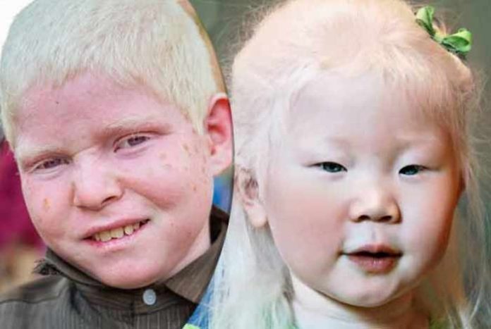 albinism types symptoms causes treatment and prevention