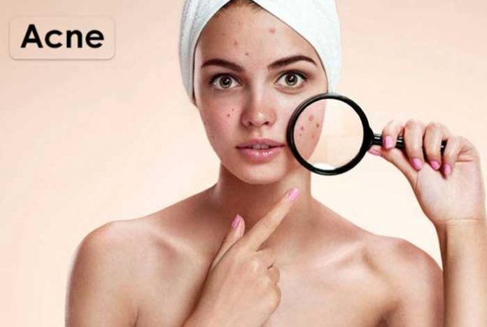 all about acne causes & treatments types prevention and symptoms