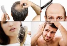 Baldness – Symptoms, Causes, Pattern, Prevention and Treatment baldness symptoms causes pattern prevention and treatment