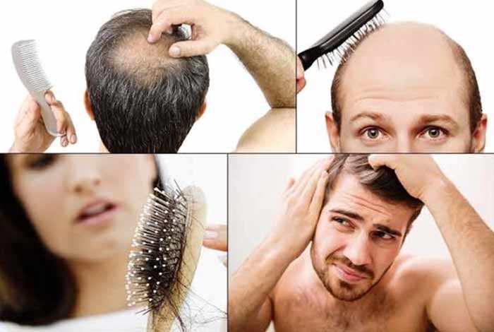 Baldness – Symptoms, Causes, Pattern, Prevention and Treatment baldness symptoms causes pattern prevention and treatment