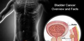 bladder cancer types causes symptoms prevention and treatment