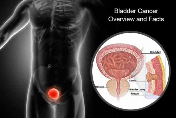 bladder cancer types causes symptoms prevention and treatment