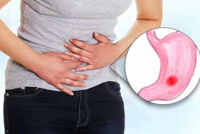 irritable bowel syndrome ibs types causes prevention and treatment