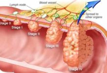 research suggests colon cancer screening should be in early 40s and not at