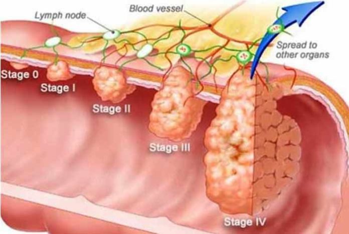 research suggests colon cancer screening should be in early 40s and not at