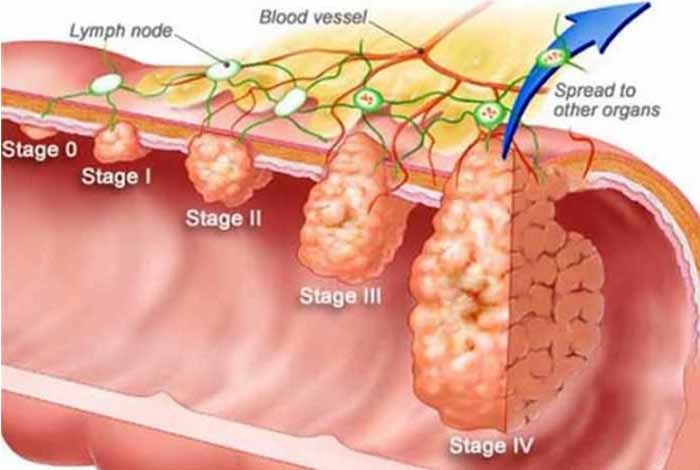 research suggests colon cancer screening should be in early 40s and not at
