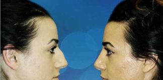 Rhinoplasty might make you more attractive, healthier and successful rhinoplasty might make you more attractive healthier and successful