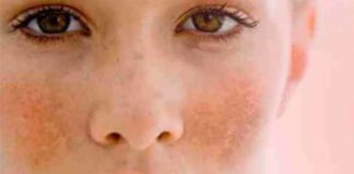 Serum zinc deficiency associated with melasma serum zinc deficiency associated with melasma