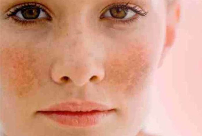 serum zinc deficiency associated with melasma