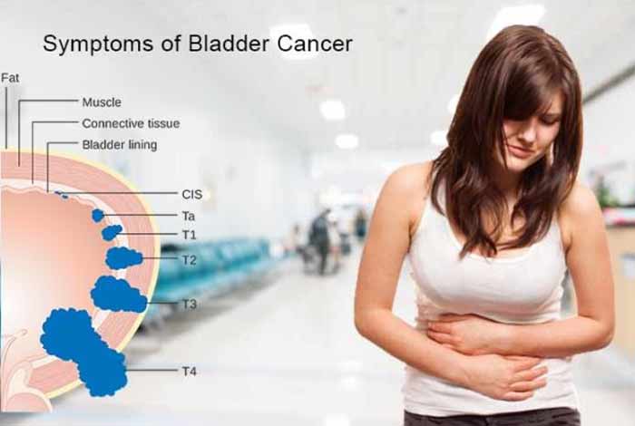 symptoms of bladder cancer