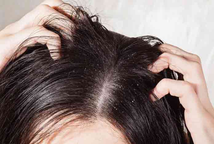 3. Hair Fall – What Role does Dandruff Play in It?