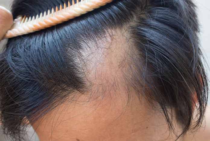 4. Hair Fall – What Role does Dandruff Play in It? 