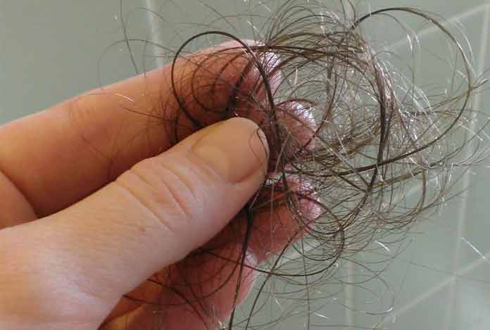 5. Hair Fall – What Role does Dandruff Play in It?
