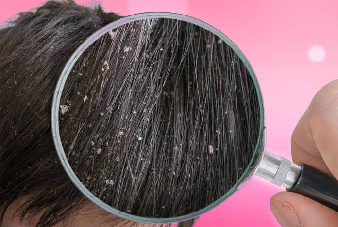 6. Hair Fall – What Role does Dandruff Play in It?