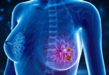 Breast Cancer