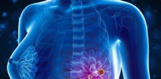 Breast Cancer