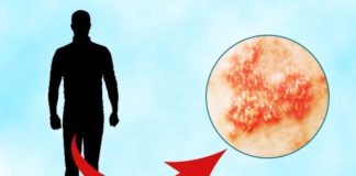 Genital Herpes