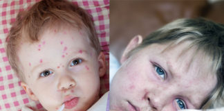 Measles: Types, Symptoms, Prevention and Treatment