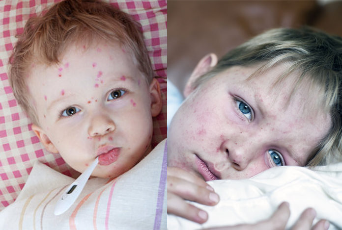 Measles: Types, Symptoms, Prevention and Treatment