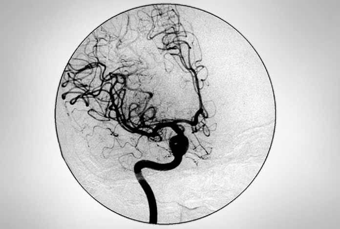 Peripheral Aneurysm