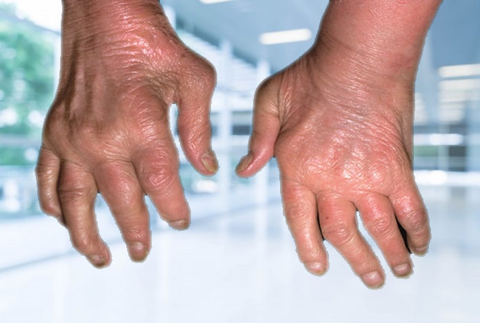 Psoriatic Arthritis: Types, Symptoms, Causes and Treatment