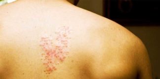 Shingles