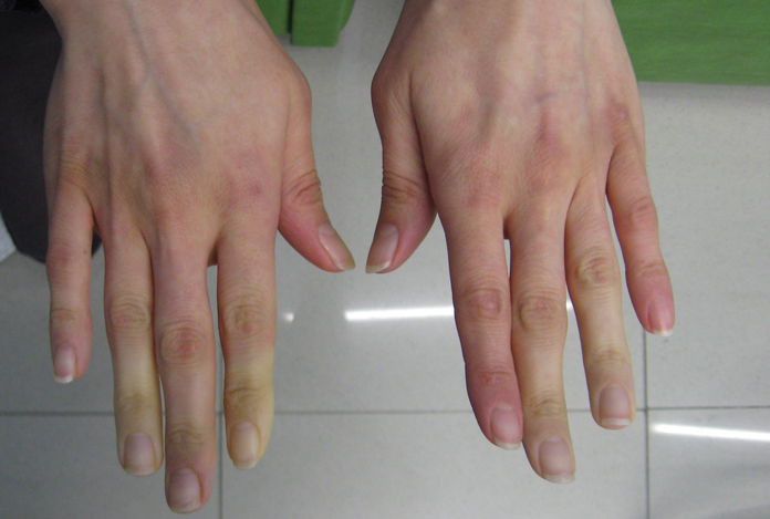 Symptoms of Psoriatic Arthritis