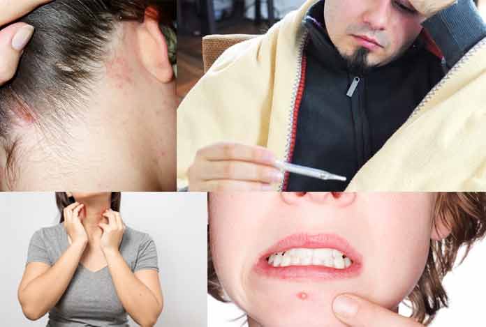 Symptoms of Shingles