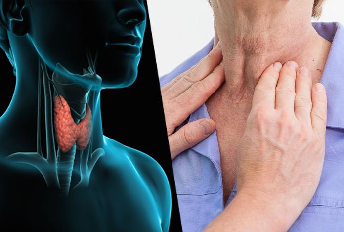 Thyroid storm for Hyperthyroidism