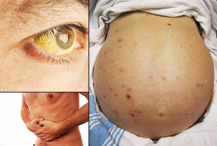 Liver Cirrhosis Rash