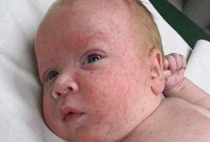 Types and Symptoms of Measles