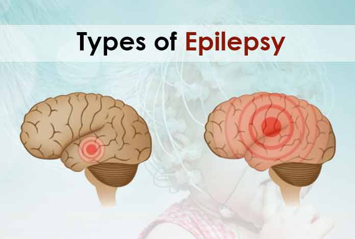Types of Epilepsy