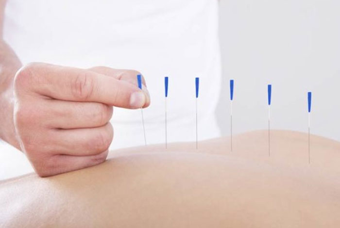 acupuncture