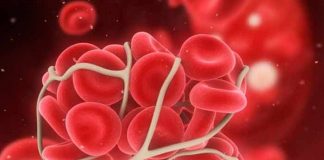antiphospholipid syndrome symptoms causes prevention and treatment