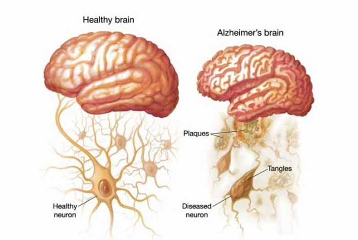 causes of alzheimer’s disease