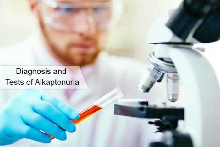 diagnosis and tests of alkaptonuria