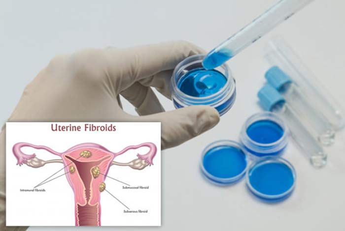 diagnosis and tests of ovarian cancer