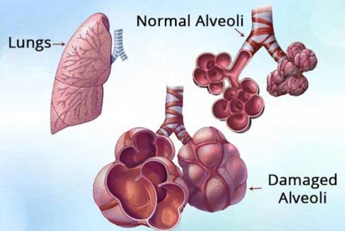 emphysema types symptoms causes prevention and treatment