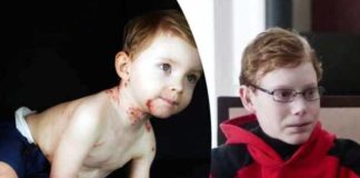 gene therapy gives new life to butterfly child suffering from epidermolysis bullosa a genetic disease